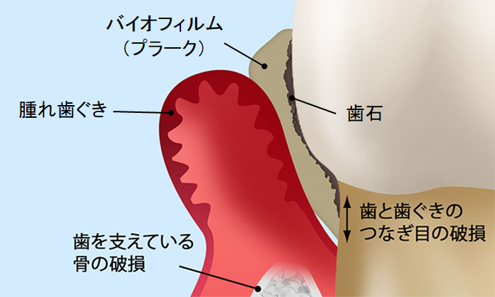 歯周病の原因