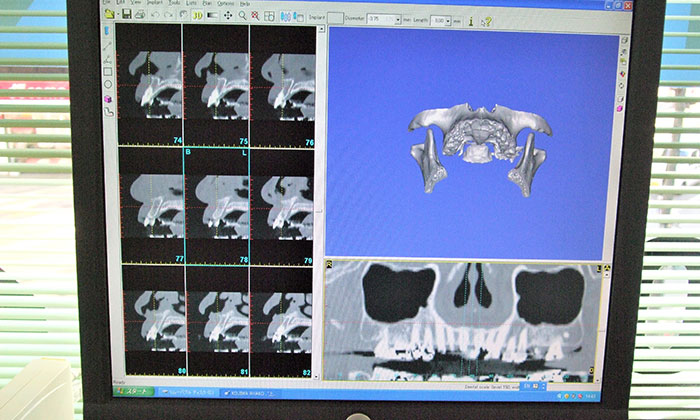 インプラント診断用システム「シムプラント」