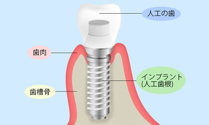 インプラント治療について