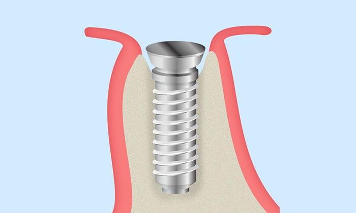 顎の骨に人工歯根を埋め込みます